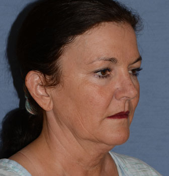 facelift neck lift